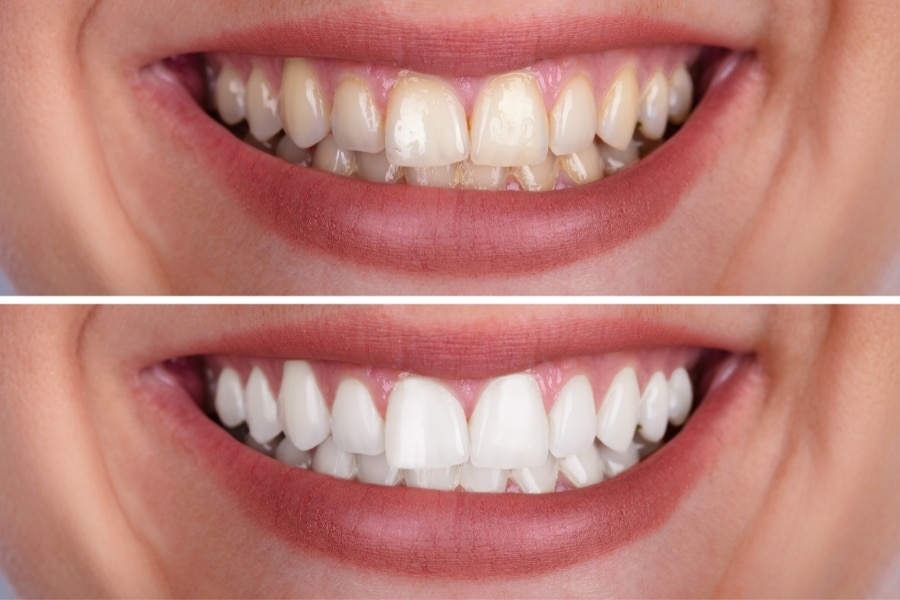 Evite dores e sensibilidade com 5 cuidados eficazes durante o clareamento dental. Saiba como clarear com segurança usando V34.